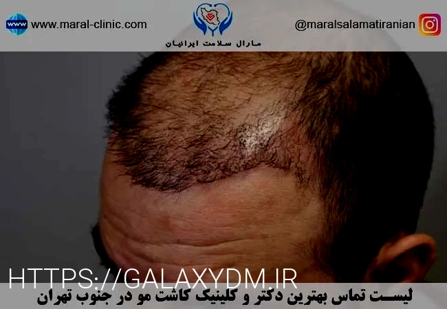 کاشت مو تهران